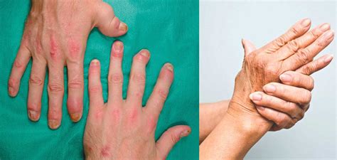 All You Need To Know About The Psoriatic Arthritis Symptoms And Causes