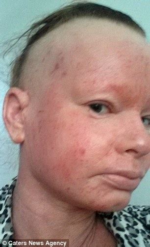 Extreme Eczema Sufferer Quits 30 Year Steroid Cream Addiction Is Left