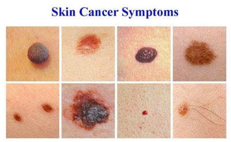 Skin Cancer Blue Velvet