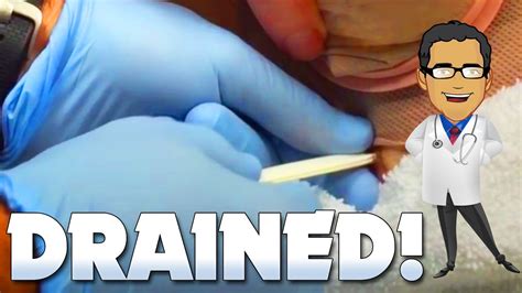 Abdominal Drain Removal Cysts Wounds Abscesses Youtube