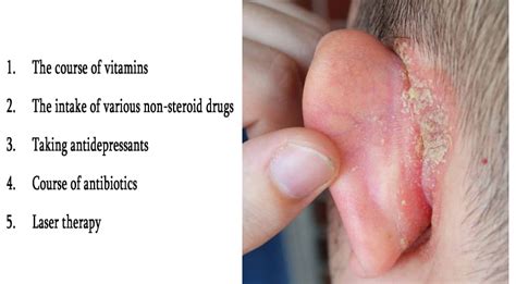 Psoriasis In Ears Causes Symptoms And Treatment Psoriasis Expert