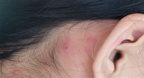 Heres How You Can Treat Pimples Behind The Ears Read Health Related