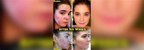 youtube stars who battled acne say they cleared skin through a low fat diet abc news
