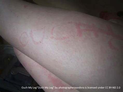 26 Images Of Hives Urticaria On Skin