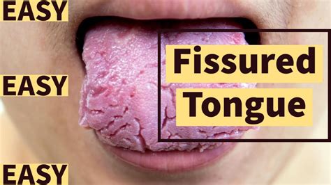 Fissured Tongue Easy Youtube
