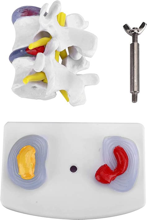 Anatomical Lumbar Disc Herniation Demonstration Model Human Spine Hot