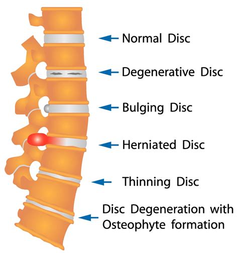 Herniated And Bulging Discs Symptoms To Look For Physical Therapy