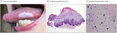 A White Patch On The Tongue Dermatology Jama Dermatology Jama