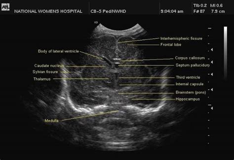 Cranial Ultrasound A Guideline For The Performance Of Routine Cranial