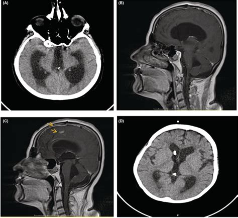 A Axial View Brain Ct Without Contrast Demonstrates Severe