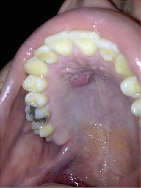 The lumps caused by canker sores can range from being quite small to large clusters of sores that are very painful. Lump On Roof Of My Mouth - Oral Sex