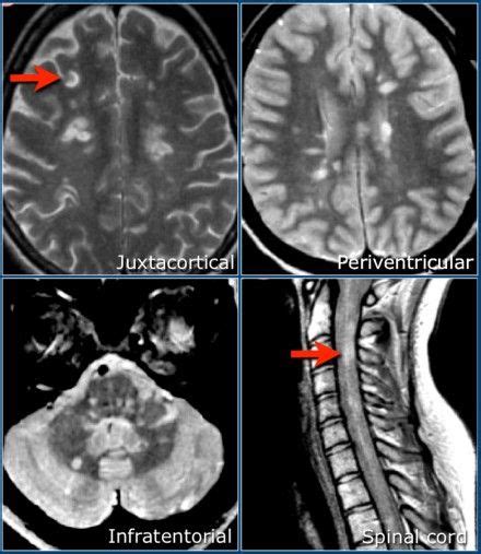 Pin By Lucy Ace On Ms Multiple Sclerosis Brain Lesions Radiology