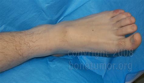 Giant Cell Tumor Foot And Ankle