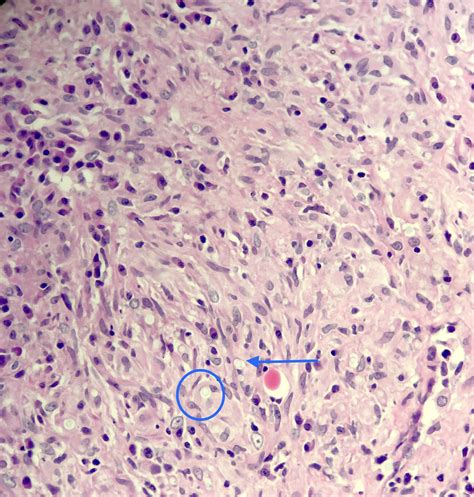 Cryptococcus Neoformans Meningitis