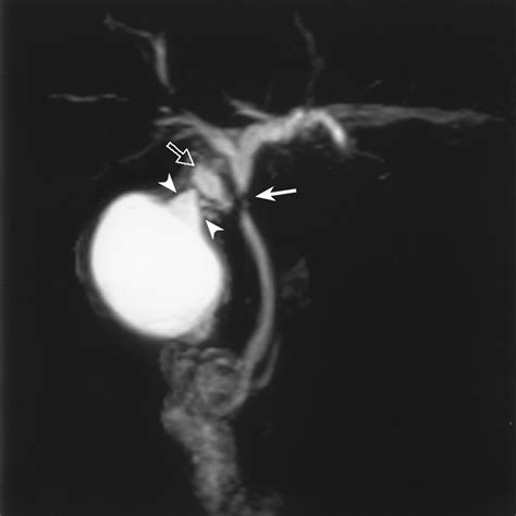 Diagnostic Pitfalls Of Mr Cholangiopancreatography In The Evaluation Of