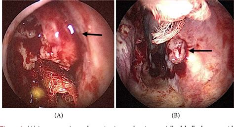 Figure 2 From Benign Salivary Gland Tumour Presenting As Unilateral