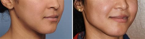 Female Jaw Angle Implants Result Oblique View Dr Barry Eppley