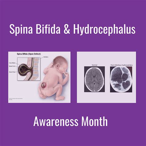 Spina Bifida And Hydrocephalus Awareness Month