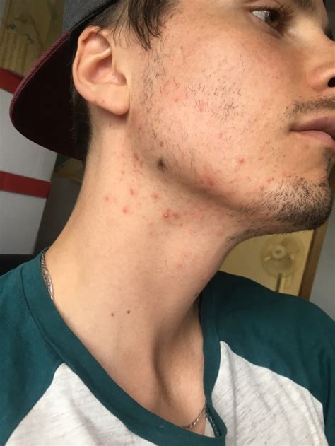 Male Hormonal Acne Help Tried Everything Hormonal Acne