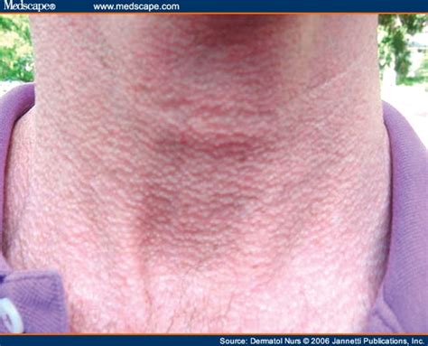 Skin Rashes In A Patient With Antibodies To Ross A