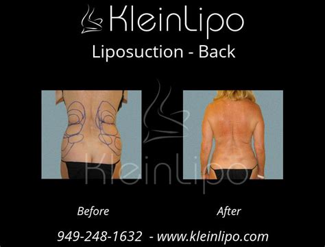 Back Liposuction Kleinlipo Liposuction Surgery Of Orange County