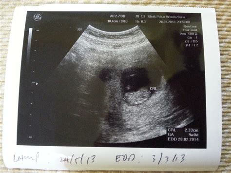 Kehamilan 7 minggu janin belum terlihat normal kah? NinaAz the Beauty of Life: First Trimester of pregnancy