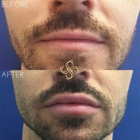 Before And After Lips — Skintight Aesthetics