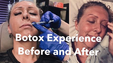 Lip Flip Botox Experience And Footage Before And After What To