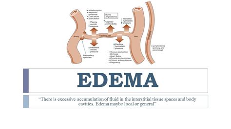 Edema Types Grading Cause Pathophysiology Treatment And