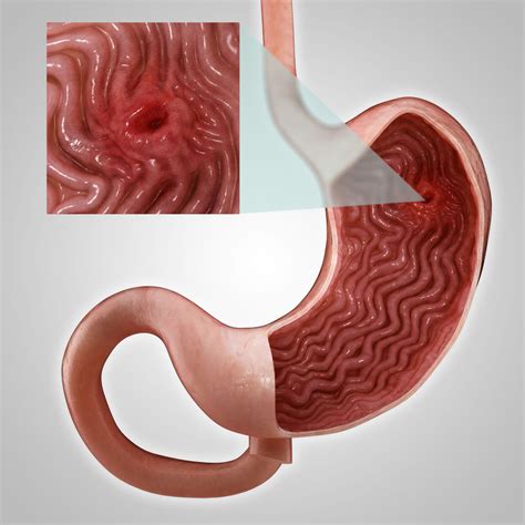 Stomach Ulcers