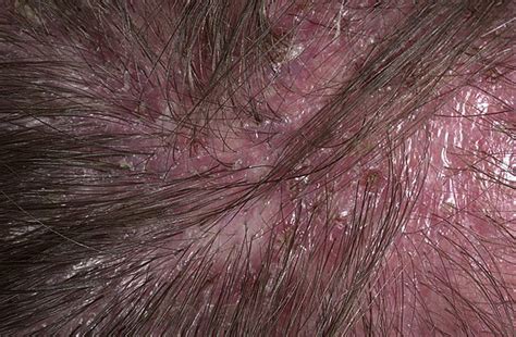 Folliculitis On Head Pictures 54 Photos And Images