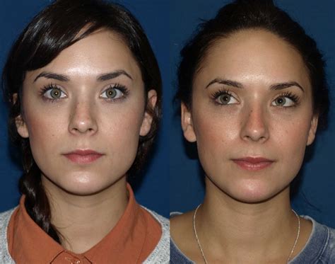 Revision Rhinoplasty Before And After Photos