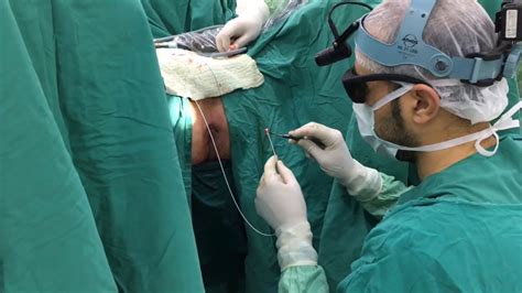Laser Perianal Fistula Surgery Laft Youtube