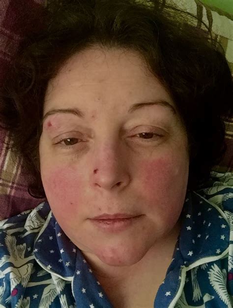 Lupus Can Cause A Red Butterfly Shaped Rash Across The Nose And Cheeks