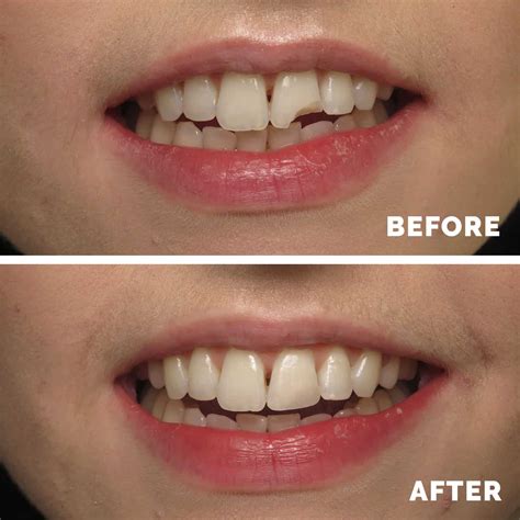 Cosmetic Dental Bonding Guide Procedure Costs And Alternatives