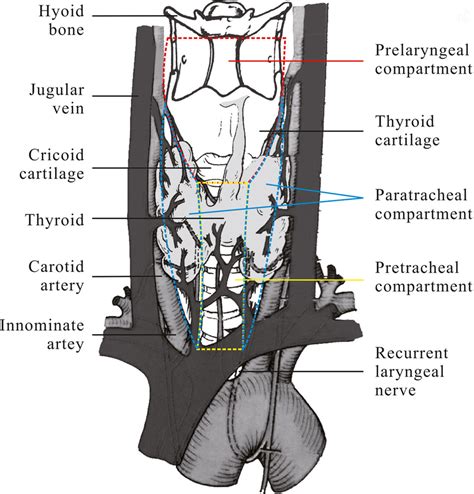 Subgroups Of The Central Compartment Prelaryngeal Lymph Node