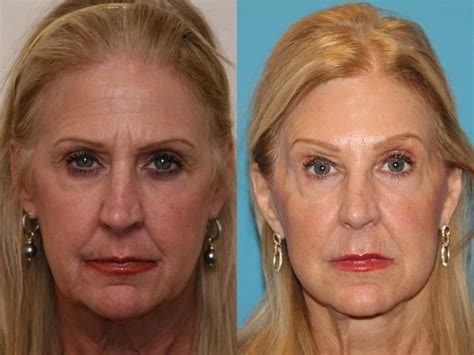 Facial Rejuvenation Before And After Pictures Case 45 Atlanta Georgia Buckhead Facial