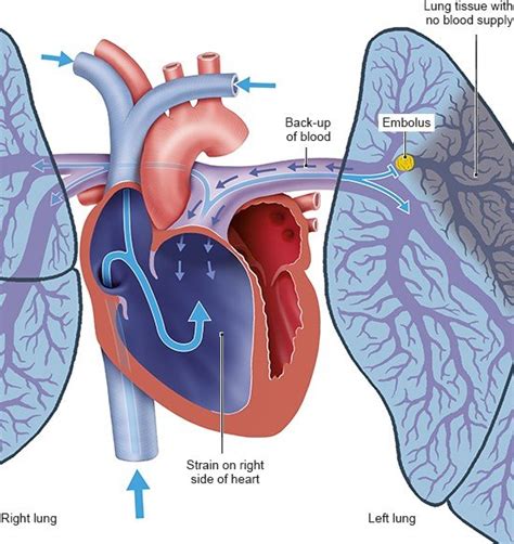 Pulmonary Embolism