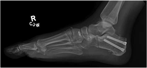 Single And Double Osteotomies Of The Calcaneus For The Treatment Of