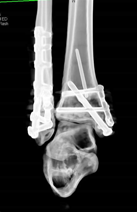 Open Reduction Internal Fixation Orif Of Tibia And Fibular Fractures