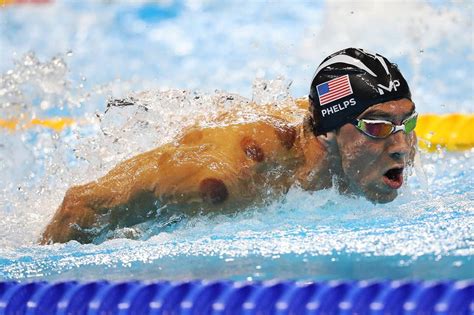 What Is Cupping Therapy And Why Do Olympians Like Michael Phelps Use It London Evening