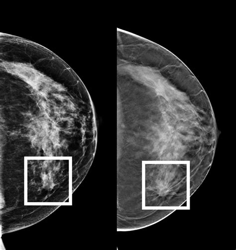 The Image On The Left Is An Example Of 2d Mammography While The Image