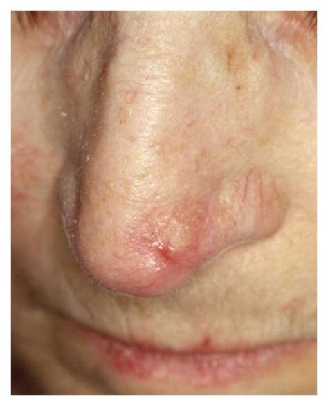 What Does Skin Cancer On Your Nose Look Like Idaman