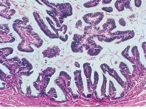 Borderline Ovarian Tumors Atypical Proliferative Ovarian Tumors Glowm