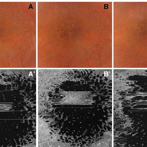 Fundus Photography And Structural Optical Coherence Tomography B Scan