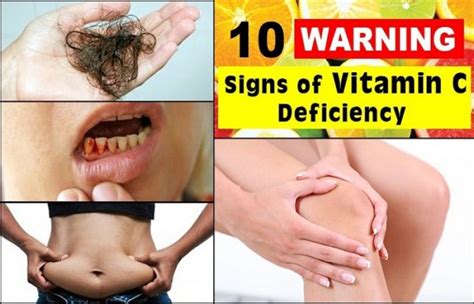 Common Symptoms Of Vitamin C Deficiency Fastnewsfeed