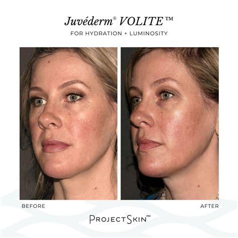 Our Solution For Summer Skin Hydration Juvederm Volite Project Skin Md