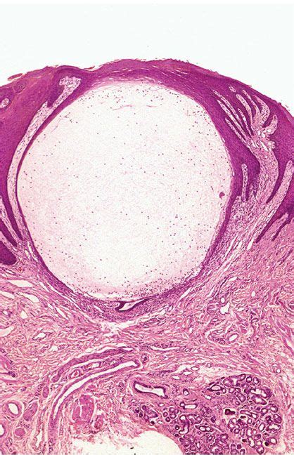 Tumors Of Fibrous Tissue Involving The Skin Plastic Surgery Key