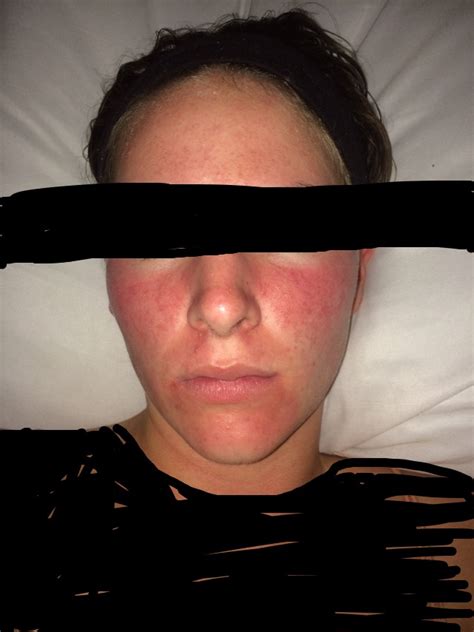 Redness On Cheeks Rosacea And Facial Redness Forum
