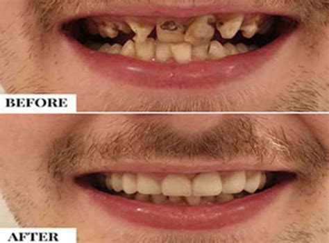Crooked Tooth Correction Straighten Crooked Teeth Delhi